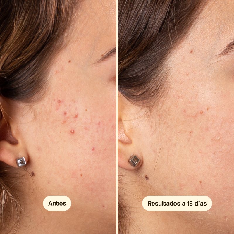 Azelaic Radiance Face Treatment