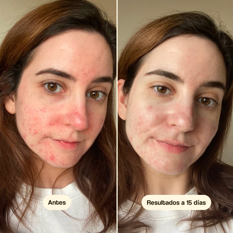 Azelaic Radiance Face Treatment