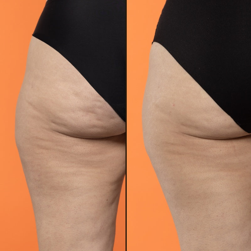 Mini Beta-Burner Sculpting Treatment