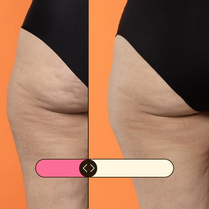 Refill Beta-Burner Sculpting Treatment